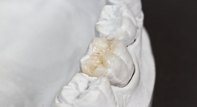 ricostruzione dentale padova e treviso