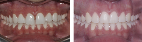 Ortodonzia estetica