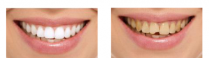 dental aesthetic bonding