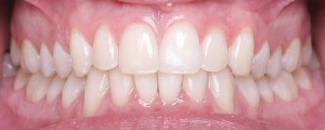 gum contouring