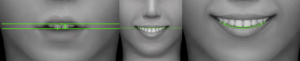 smile makeover