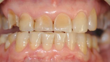 Cos’è l’erosione dentale