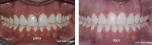 Prima e dopo trattamento ortodontico