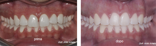 Prima e dopo trattamento ortodontico