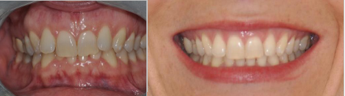 rimodellamento_estetico_dentale_padova_treviso