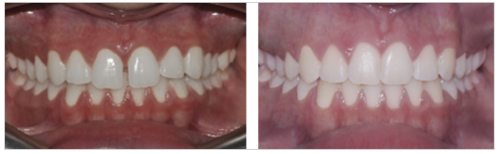 curare-diastema