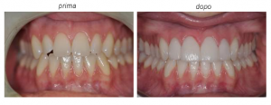 trattamento faccette dentali - Padova e Treviso