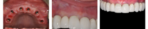 Riabilitazione in bioceramica su impianti