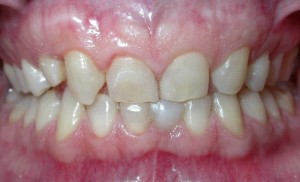 corone in zirconia ceramica