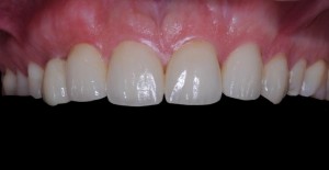 corone in zirconia ceramica Padova Treviso