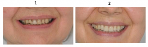 trattamento ringiovanimento sorriso