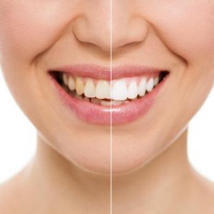 RICOSTRUZIONI DENTALI PADOVA E TREVISO