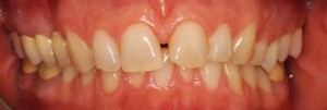 corone-dentali-padova